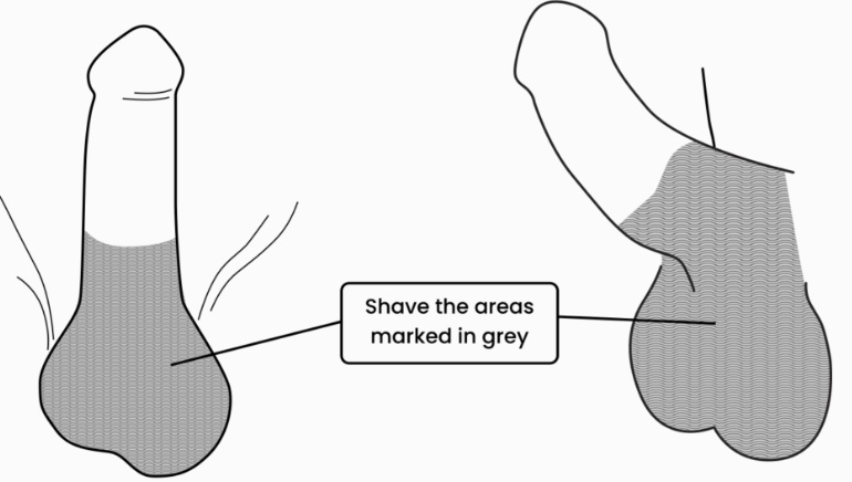 Vasectomy Shaving Instructions
